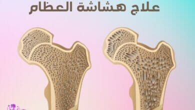 علاج هشاشة العظام Osteoporosis treatment