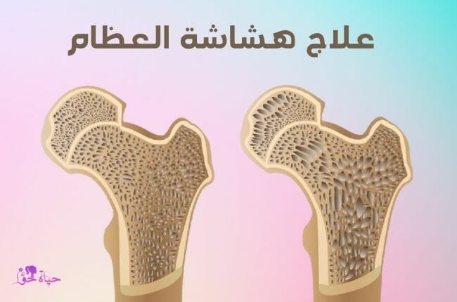 علاج هشاشة العظام Osteoporosis treatment