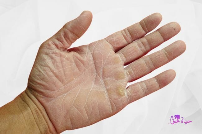 جفاف الجلد skin dryness