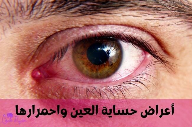 أعراض حساسية العين واحمرارها 