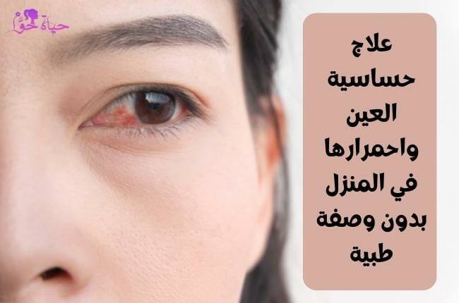 علاج حساسية العين واحمرارها