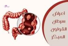 أعراض سرطان القولون المبكرة (colon cancer early symptoms)