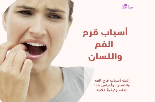 أسباب قرح الفم واللسان Causes of mouth and tongue ulcers