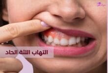 التهاب اللثة الحاد (acute periodontitis)