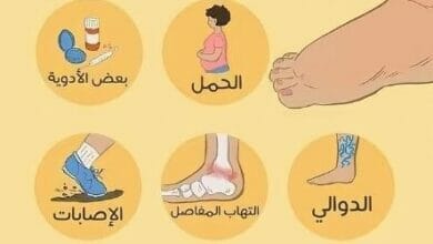 اسباب تورم القدمين Causes of swollen feet