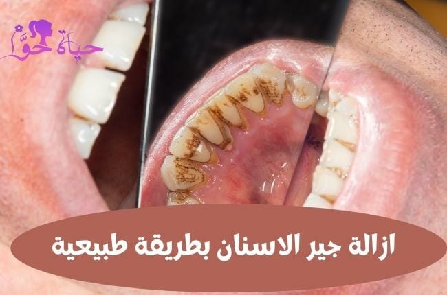 ازالة جير الاسنان بطرق طبيعية