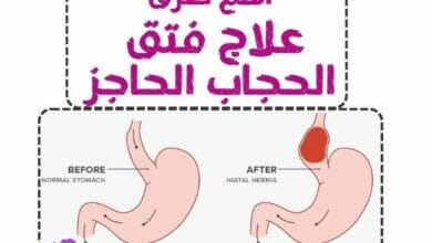علاج فتق الحجاب الحاجز hiatal hernia treatment
