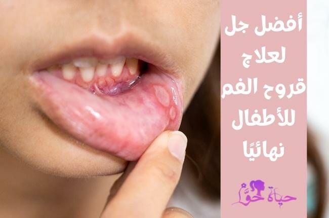 أفضل جل لعلاج قروح الفم للاطفال (Best mouth sores gel for kids)