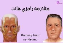 متلازمة رامزي هانت ramsay hunt syndrome