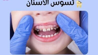 تسوس الأسنان Tooth decay