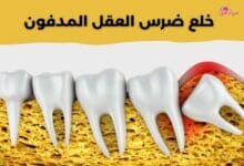 خلع ضرس العقل المدفون Extraction of a buried wisdom tooth