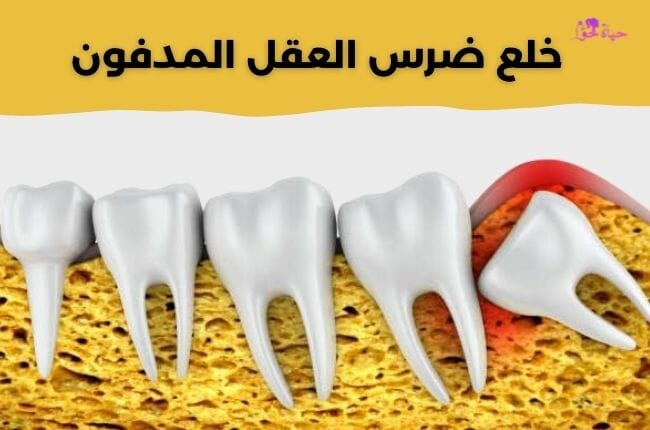 خلع ضرس العقل المدفون Extraction of a buried wisdom tooth
