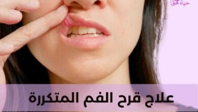 علاج قرح الفم المتكررة Treatment of recurrent mouth ulcers