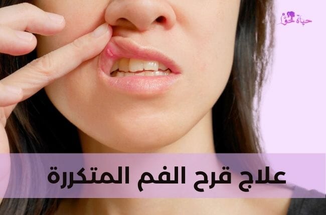 علاج قرح الفم المتكررة Treatment of recurrent mouth ulcers