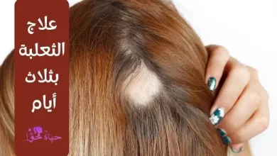 علاج الثعلبة بثلاث أيام Alopecia treatment in three days