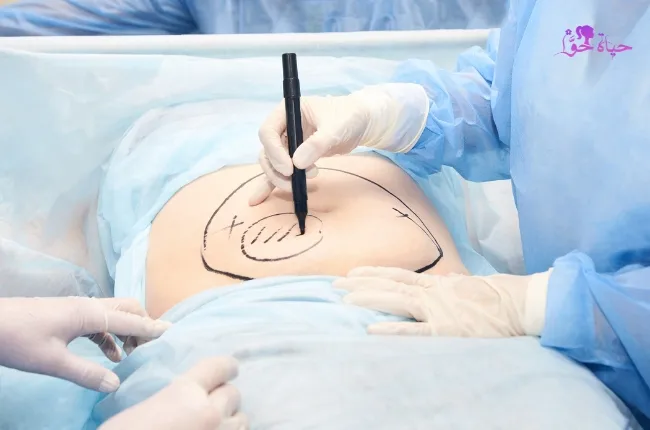 عملية استئصال الرحم hysterectomy