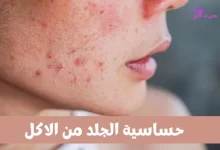حساسية الجلد من الاكل Skin allergy to food
