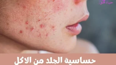 حساسية الجلد من الاكل Skin allergy to food